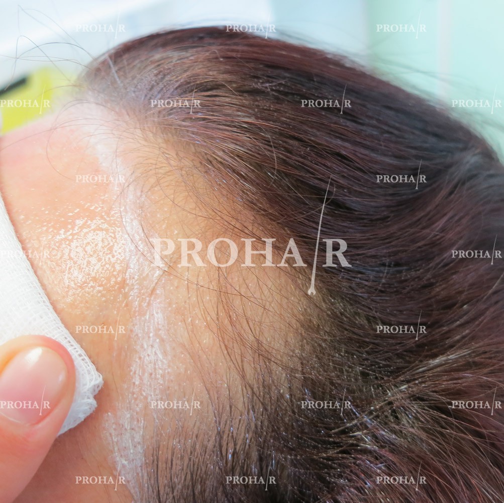PROHAIR-hair-transplant-clinic-1000-NLHT-07