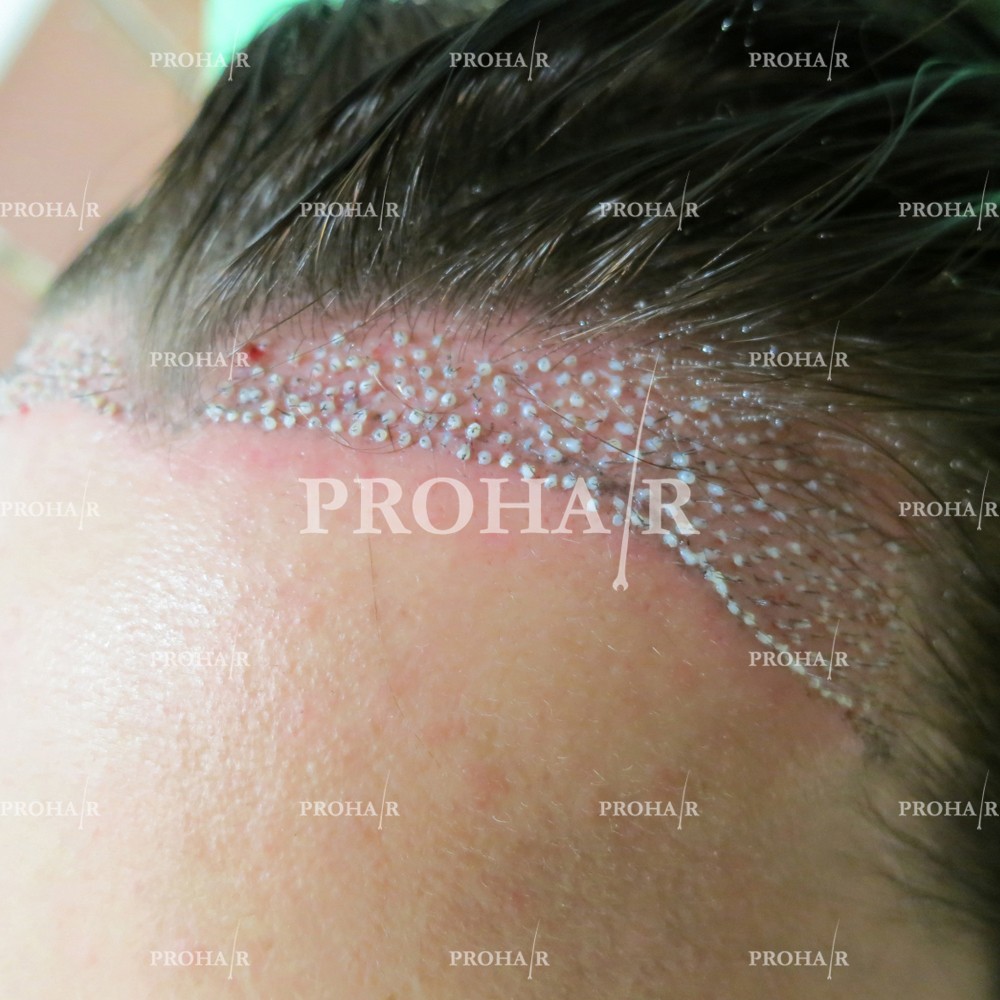 PROHAIR-hair-transplant-clinic-1500-NLHT-01