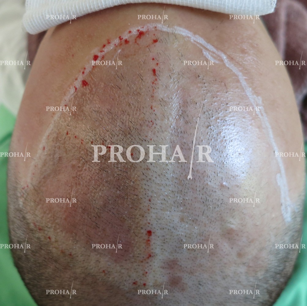 PROHAIR-hair-transplant-clinic-3000-FUE-07