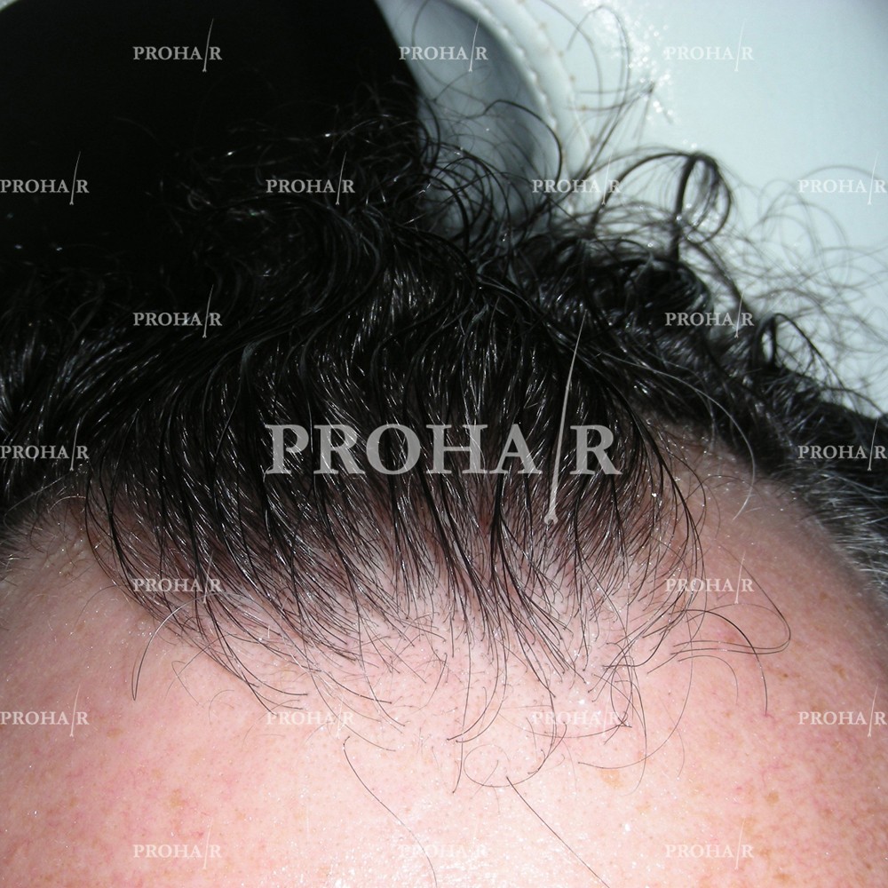 PROHAIR-hair-transplant-clinic-500-NLHT-03